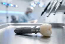 Een gedetailleerde, fotorealistische close-up van een compleet tandimplantaat, bestaande uit een titanium schroef en een porseleinen kroon, in een schone, moderne klinische omgeving.