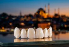 Een close-up van een set perfecte porseleinen facings op een steriele ondergrond, met op de achtergrond een prachtig wazig uitzicht op de skyline van Istanbul tijdens zonsondergang, wat het concept van tandtoerisme in Turkije illustreert.