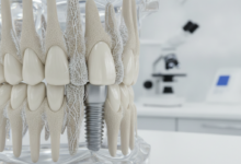 Close-up van een titanium tandimplantaat schroef die ingebed is in een doorsnede van een menselijk kaakbotmodel. De gedetailleerde botstructuur toont tekenen van botintegratie rond het implantaat. De achtergrond is onscherp, suggererend een klinische of laboratoriumomgeving.